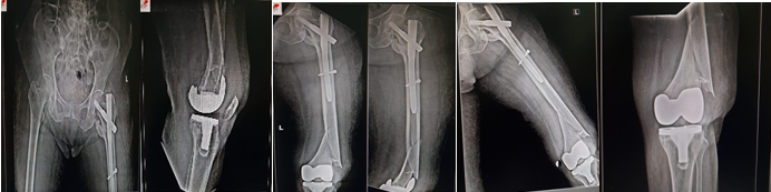 X-ray – knee, hip