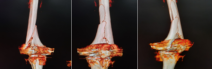 3D Reconstruction CT Images