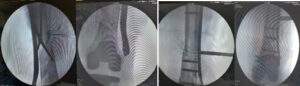 Intra Operative Fluoroscopy Pictures