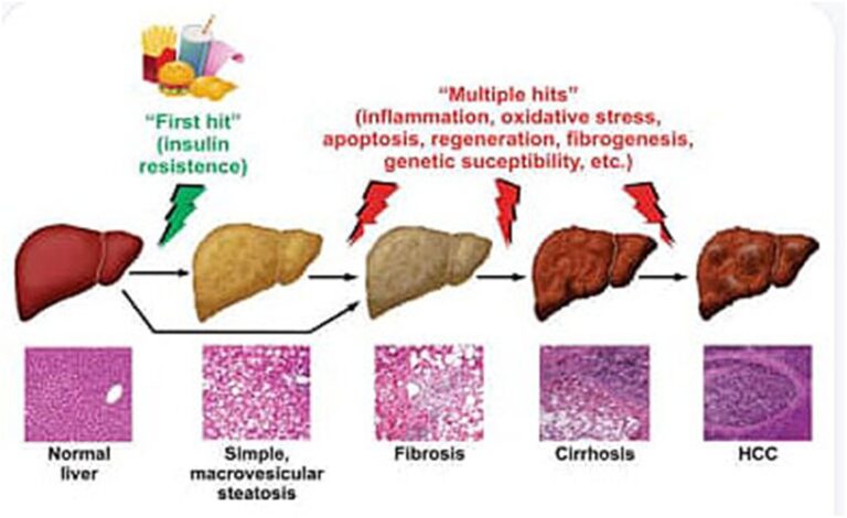 NAFLD & Metabolic Syndrome