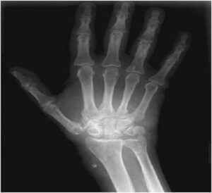 Beta 2-microglobulin amyloidosis causing carpal tunnel syndrome