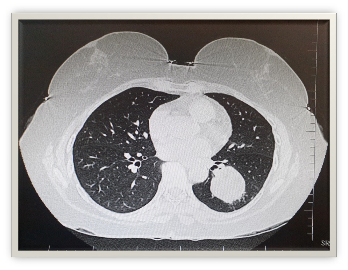 A Case of Pulmonary Hamartoma