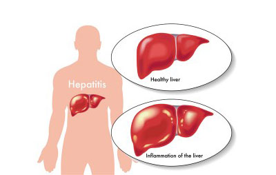 What-is-Hepatitis