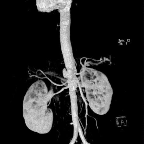 Saccular-Abdominal-Aortic-Aneurysms-5