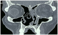 acute-viral-pneumonia