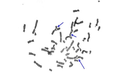 fanconi-2