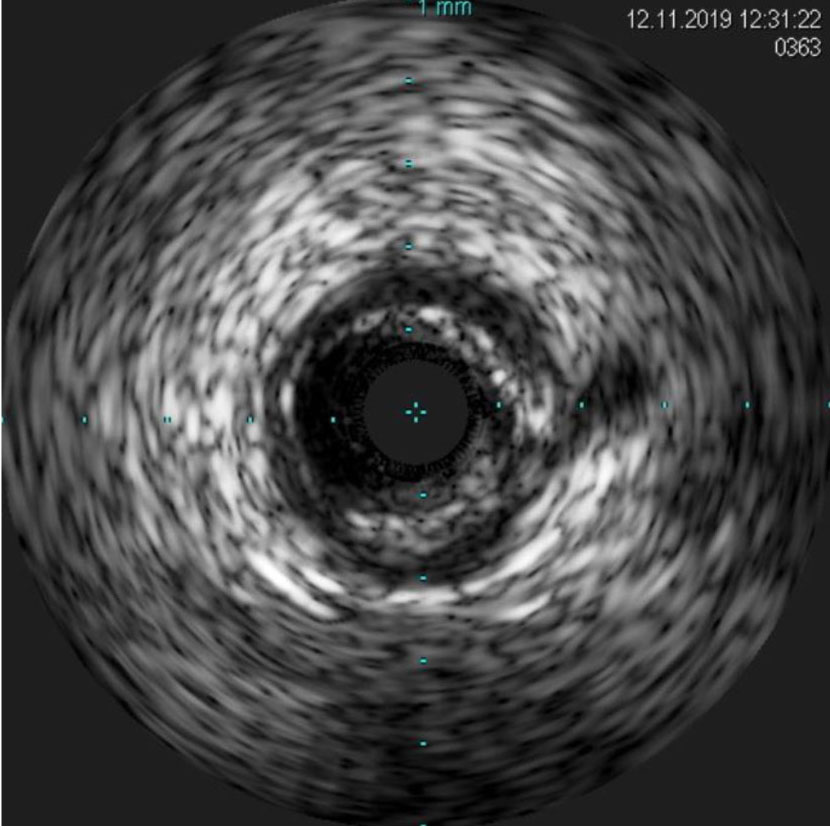 intracoronary-imaging-1-1