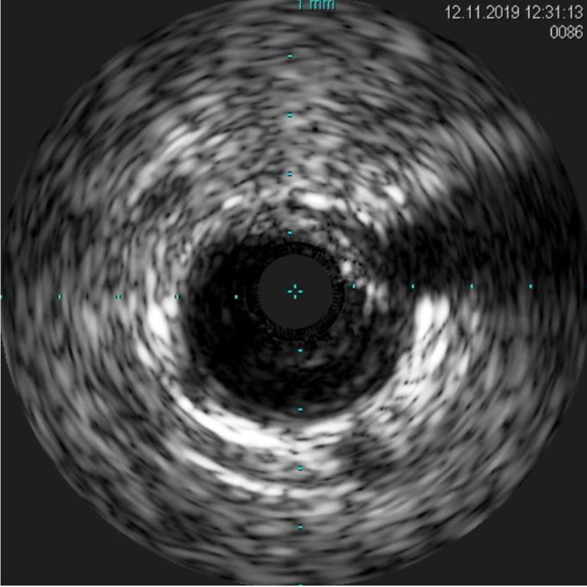 intracoronary-imaging-1