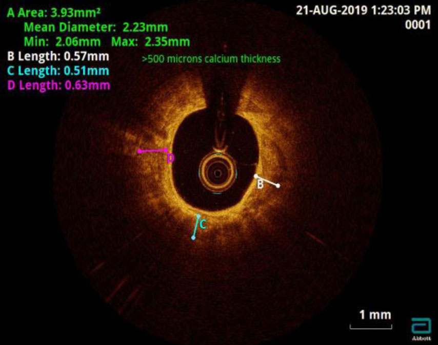 intracoronary-imaging-10