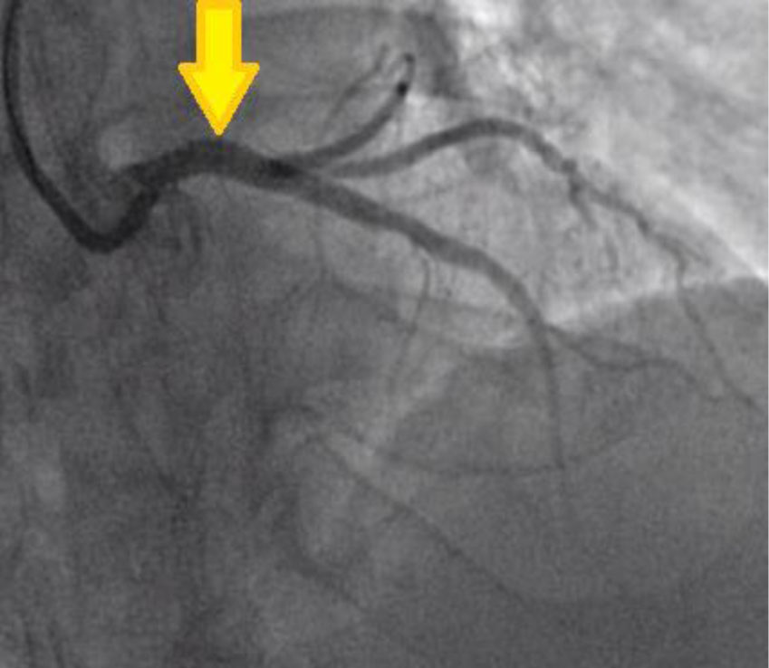 intracoronary-imaging-3