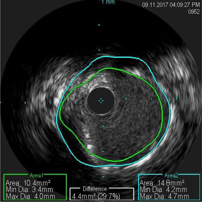 intracoronary-imaging-4