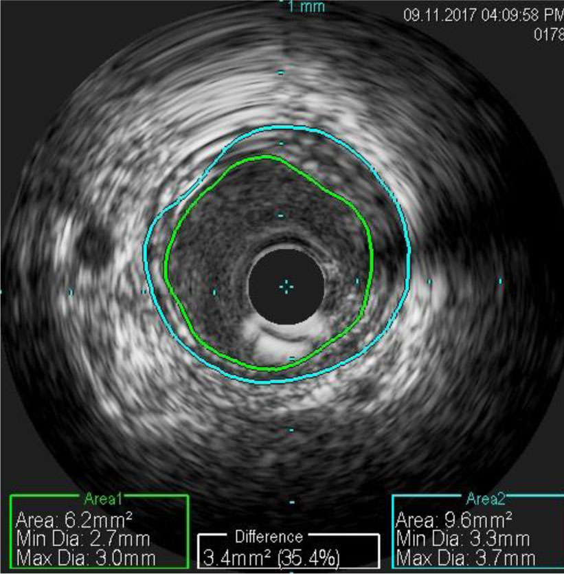 intracoronary-imaging-5