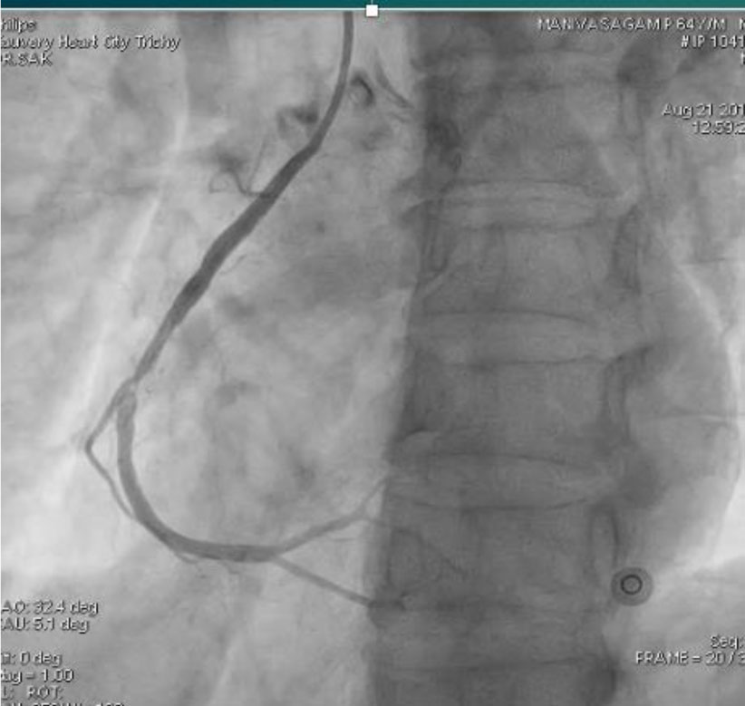 intracoronary-imaging-6