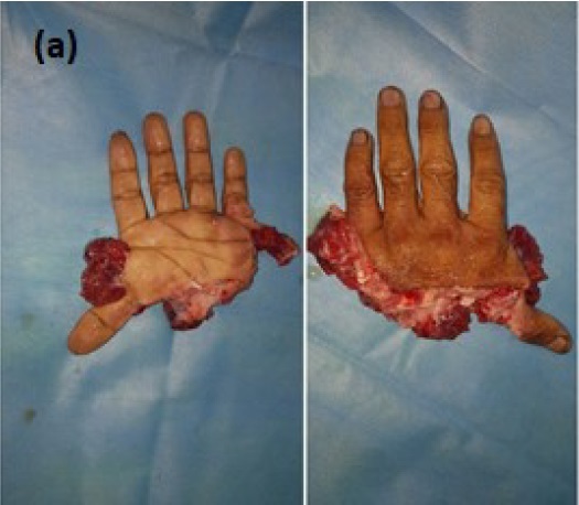 upper-limb-fig-1-a