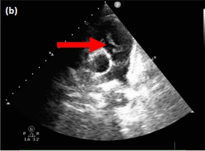 pulmonary-valve-endocarditis-image-b