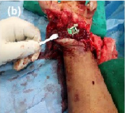 upper-limb-fig-2-b