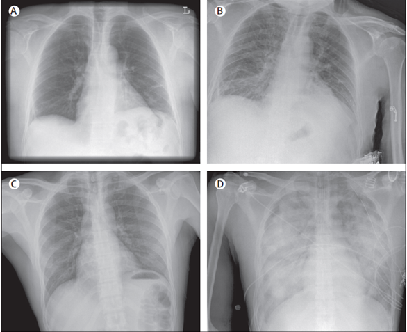 transfusion-related-acute-lung-injury-3