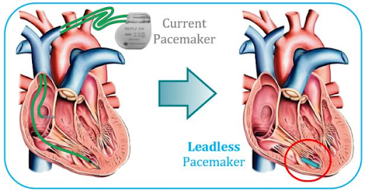 Leadless-pacemakers1