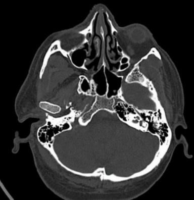 Axial-CT-brain