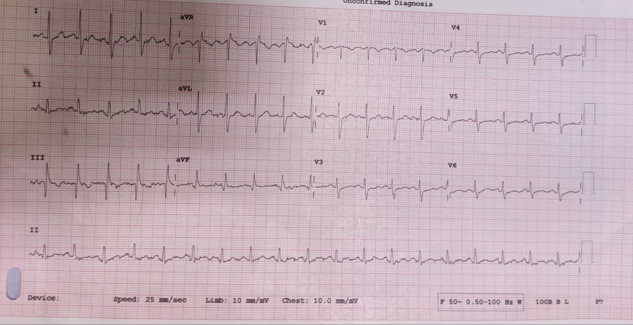 ECG