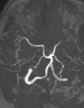 Large-PCOM-perfusing-middle-cerebral-artery