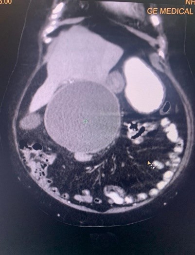 Liver-Cyst-1