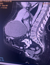 Liver-Cyst-2