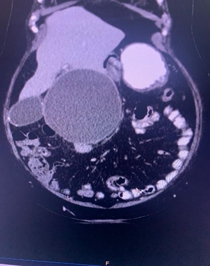 Liver-Cyst-3