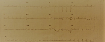 Dextrocardia-1