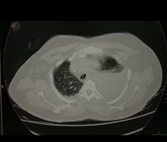 Dextrocardia-3