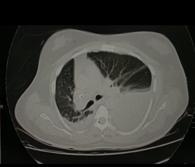 Dextrocardia-4