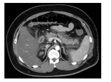 Hypertriglyceridemia-3