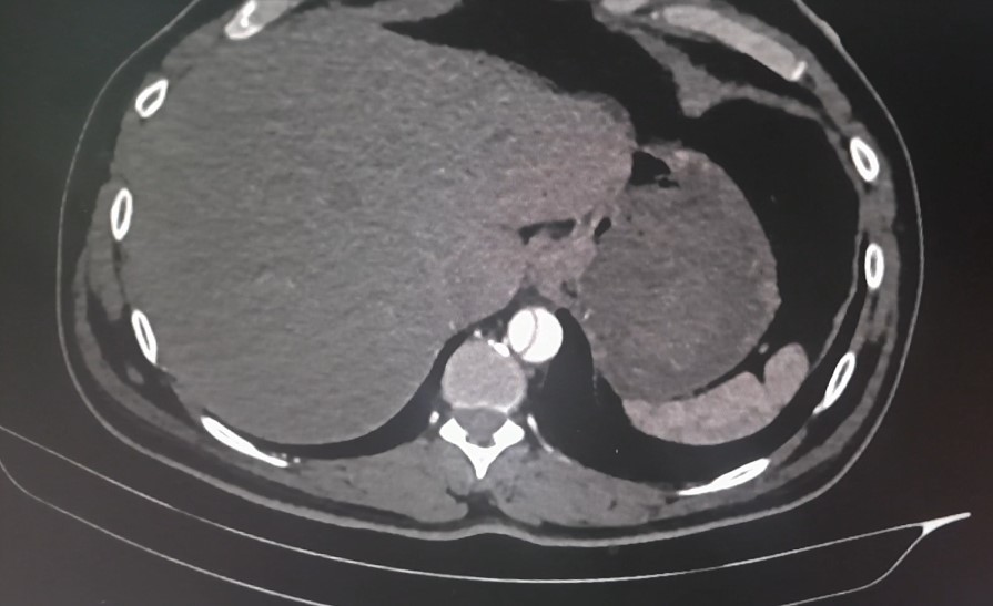 Ischemia-2