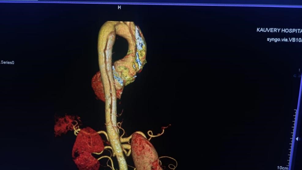 Ischemia-3