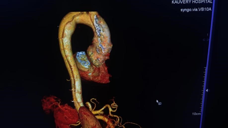 Ischemia-5