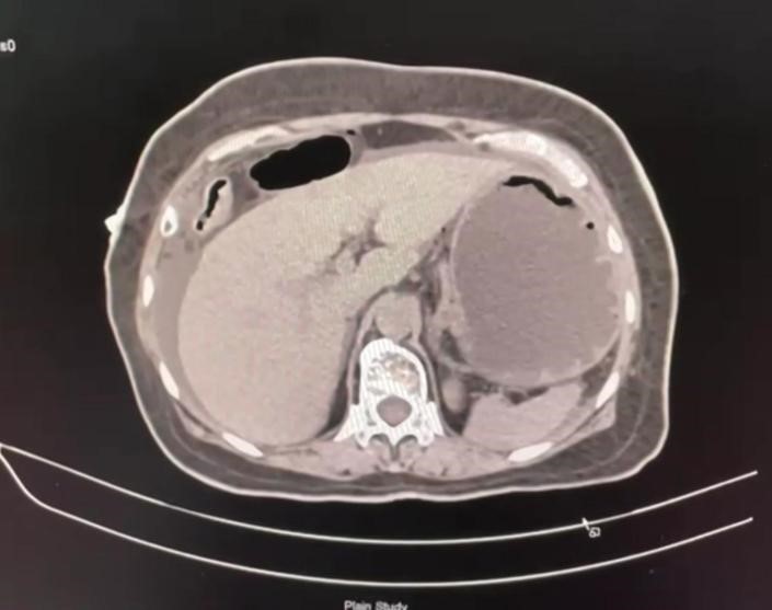 Pneumoperitoneum-3