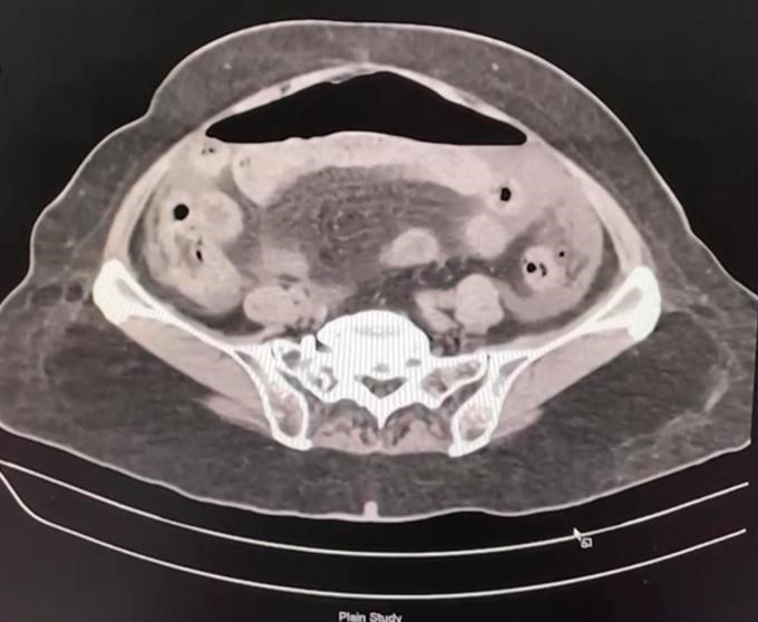 Pneumoperitoneum-5