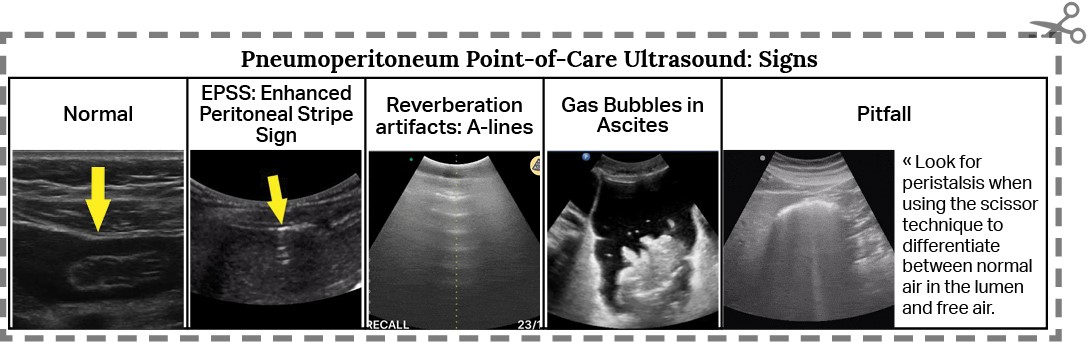 Pneumoperitoneum-7