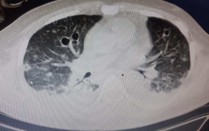 Severe-Meliodosis-2