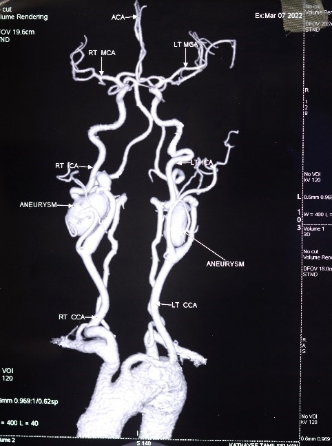 Bilateral-Carotid-aneurysms-1