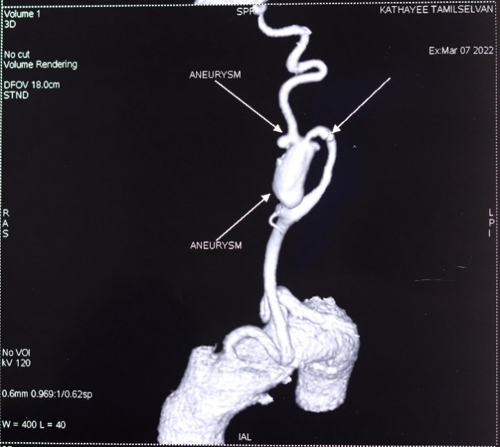 Bilateral-Carotid-aneurysms-2