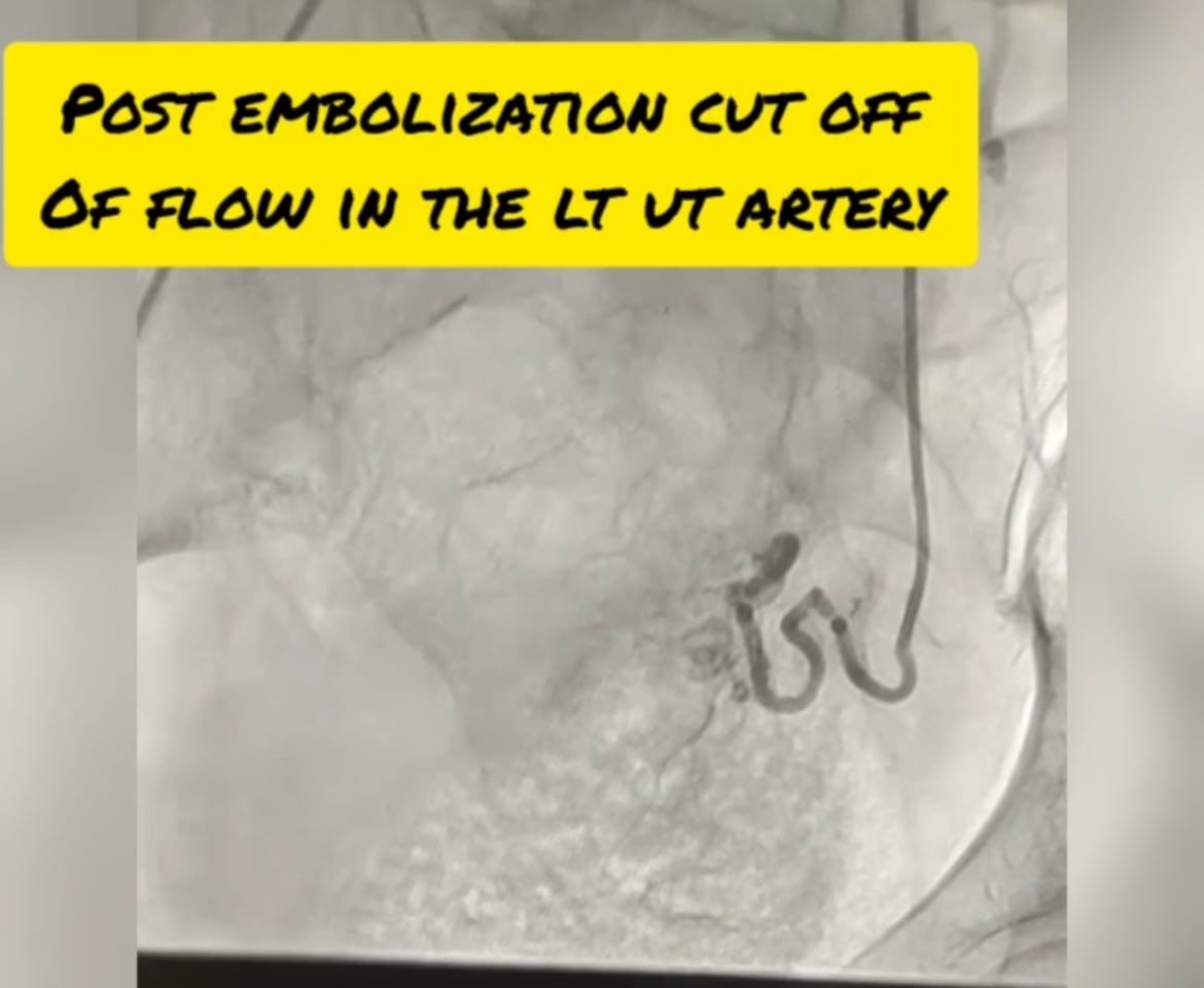 Uterine-artery-embolization-1