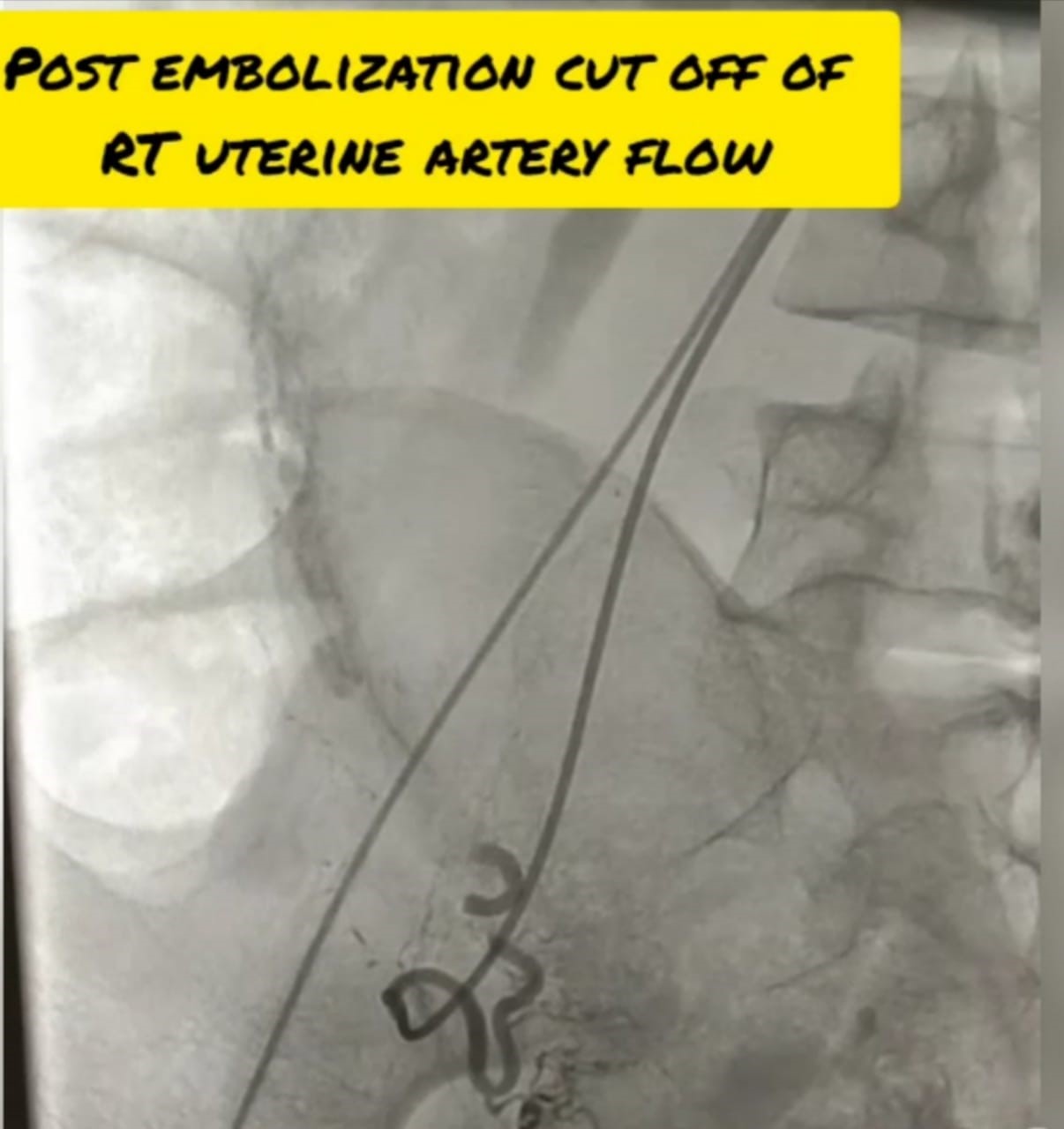 Uterine artery embolization: Saving a mother and her motherhood ...