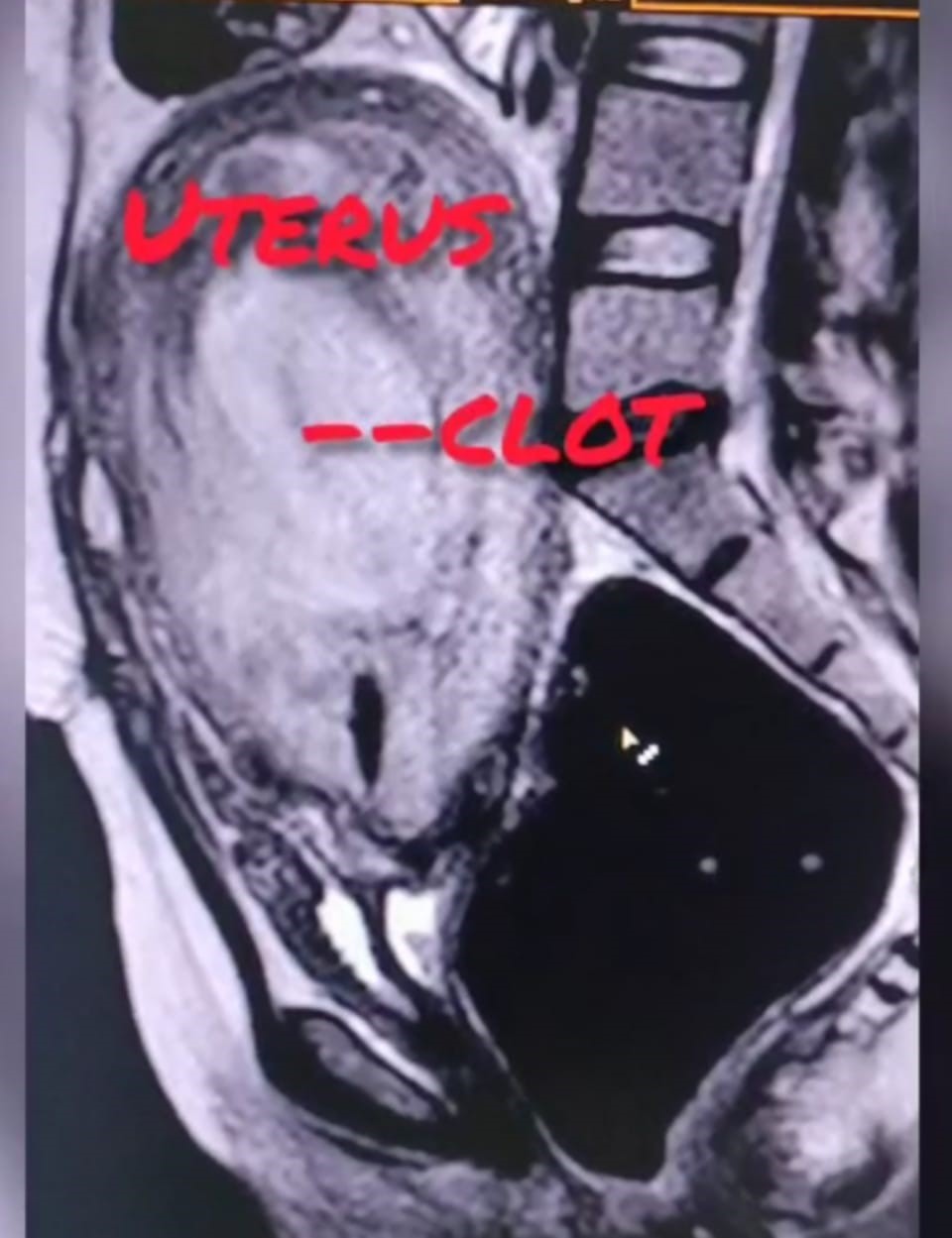 Uterine-artery-embolization-5