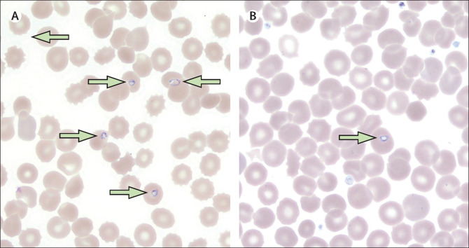 Fever-haemolysis-and-thrombocytopenia-caused-by-babesiosis
