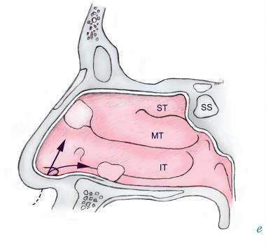 Foreign-body-in-airway-more-than-one