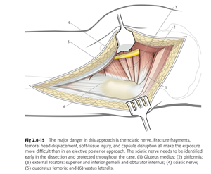 Guillain-Barre-Syndrome-6