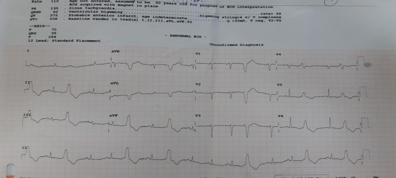 Takotsubo-cardiomyopathy