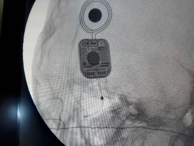 Cochlear-Implantation-2