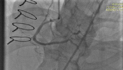 ECMO-IABP-1